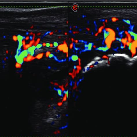 francesca bandinelli|Ultrasound discloses entheseal involvement in... : Rheumatology